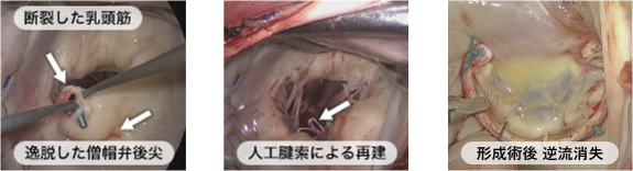 内視鏡での形成術の一例