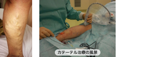 下肢静脈瘤に対するカテーテル治療