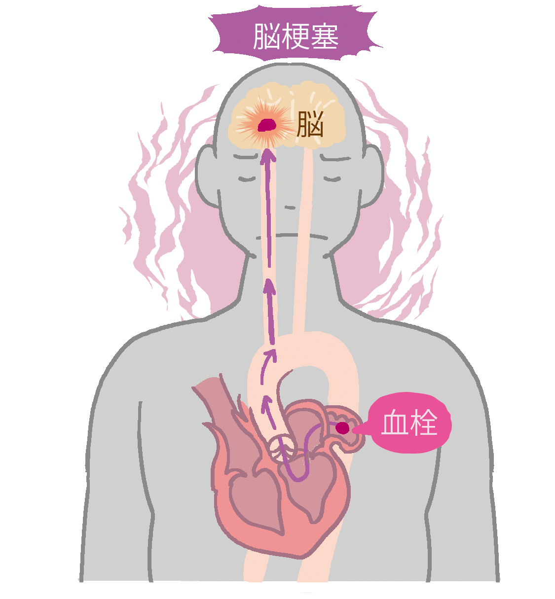 血栓が飛んでいく様子