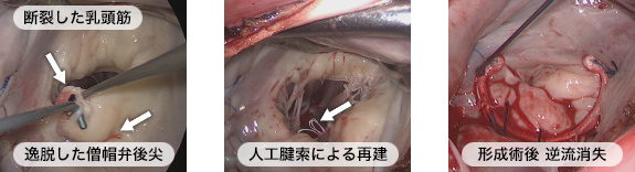 内視鏡での形成術の一例