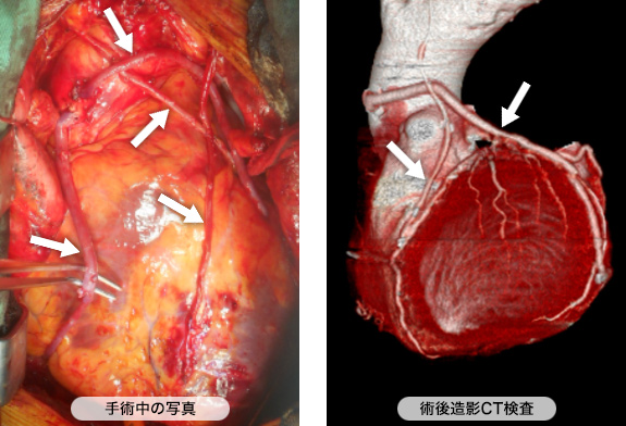 バイパスで新しく心臓につないだ血管
