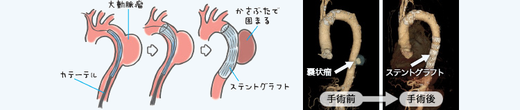 大動脈瘤に対するカテーテル治療