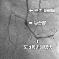 内胸動脈 – 回旋枝