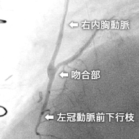内胸動脈 - 前下行枝