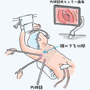 右小開胸