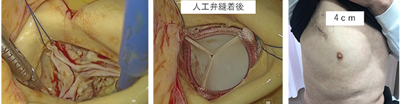 大動脈弁狭窄症に対して3D内視鏡下の大動脈弁置換術