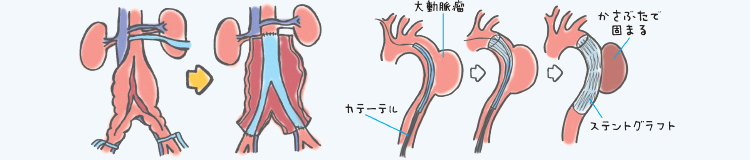 手術とカテーテル治療