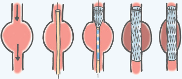 大動脈瘤の経皮的ステントグラフト内挿術