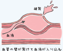 急性大動脈解離