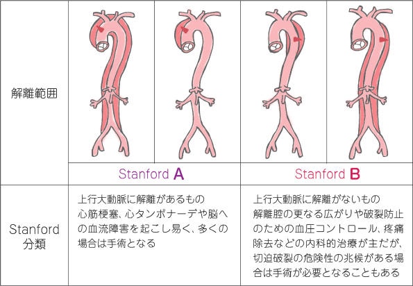 裂けた部位や範囲によって、A型とB型に分かれます。