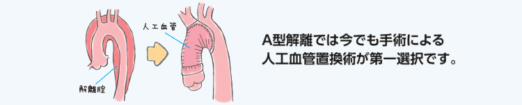 A型解離に対する人工血管置換術