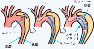 B型解離に対するステントグラフト治療