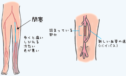 閉塞性動脈硬化症（ASO）とは