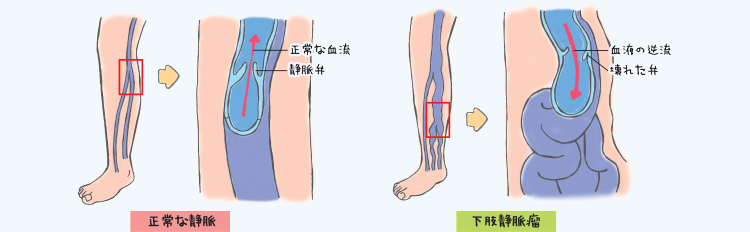 正常な静脈・下肢静脈瘤