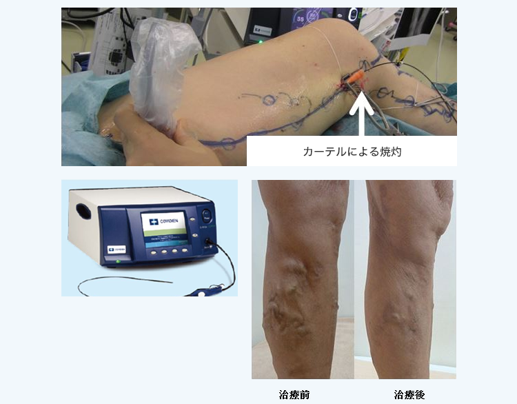 カテーテルによる治療法
