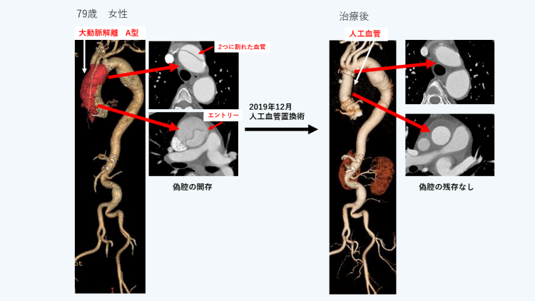 A型解離に対する人工血管置換術
