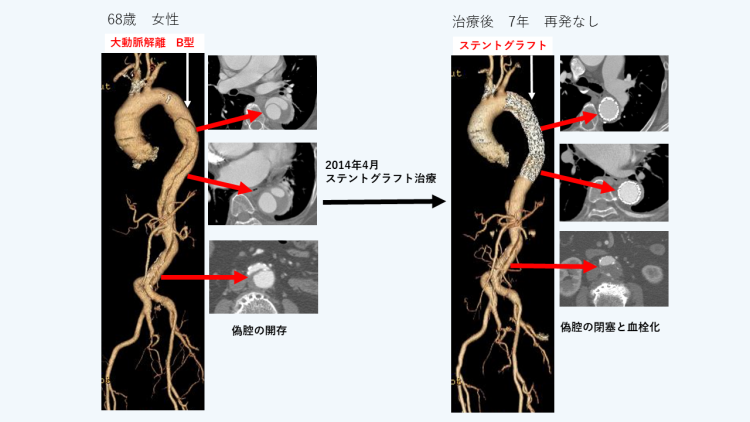 B型解離に対するステントグラフト治療