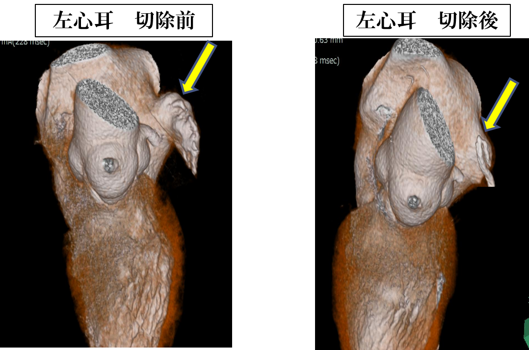 左心耳切除前後での3DCT画像