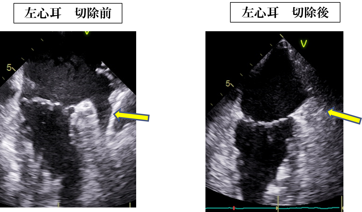 左心耳切除前後での経食道心臓超音波画像