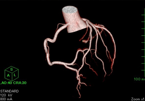 冠動脈まで描出可能なCTを導入