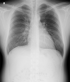 胸部の単純X線写真