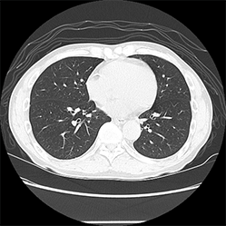 肺の横断像