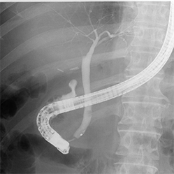 内視鏡を使って胆管・膵管を造影（ERCP）