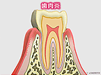 歯肉炎