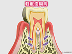 経度歯周炎