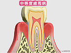 中等度歯周炎