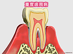 重度歯周