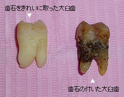 歯周病の予防と治療法