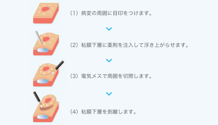 ESD（内視鏡的粘膜下層剥離術）