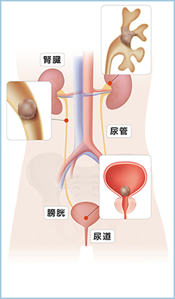 尿路結石症