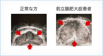 前立腺肥大症患者