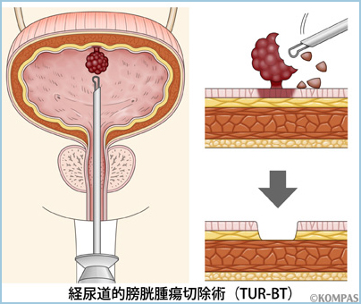 経尿道的膀胱腫瘍切除術（TUR-BT）
