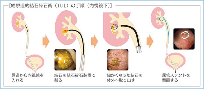 経尿道的結石砕石術（TUL）の手順（内視鏡下）